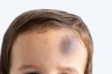 The Touch Test Every Parent Should Do After A Head Bump