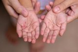 News24 | 117 cases of hand, foot, and mouth disease recorded at Durban schools, crèches