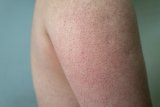 So THAT's What Those Tiny Non-Itchy Bumps On Your Arm Are