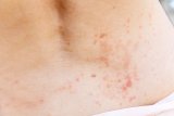 So THAT's Why Your Skin Is So Itchy Recently