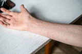 Gauteng deploys mobile clinics to combat measles outbreak