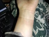 So THAT's Why The Skin Under Your Fitness Tracker Is So Red And Itchy