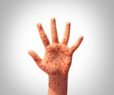 Measles outbreak confirmed in this province