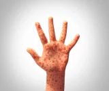 This province confirms measles outbreak