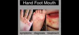Department notes concerns over Hand, Foot and Mouth Disease (HFMD), clarifying it's not related&nbsp;(…)