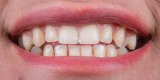 Semaglutide Users Are Reporting 'Ozempic Teeth' – But It May Not Be What They Think