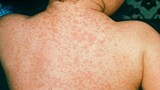 Rising measles outbreaks in South Africa amid falling vaccination rates