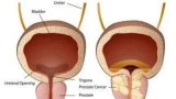 Fighting SA’s most common male cancer