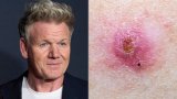 Gordon Ramsay's Skin Cancer Can Show Up As A 'Spot' – Here's How To Check Yours